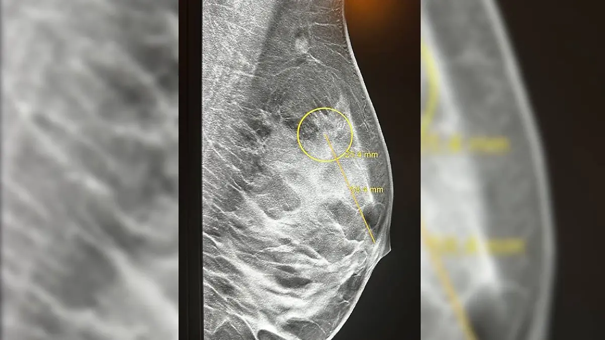 Sarah Reimann hatte besonders aggressiven Brustkrebs.