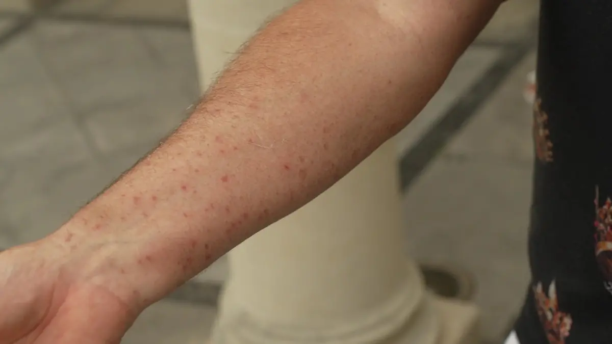 Die Ameisen haben Hubert total durchstochen, daher trägt er nun regelmäßig Gel auf. 