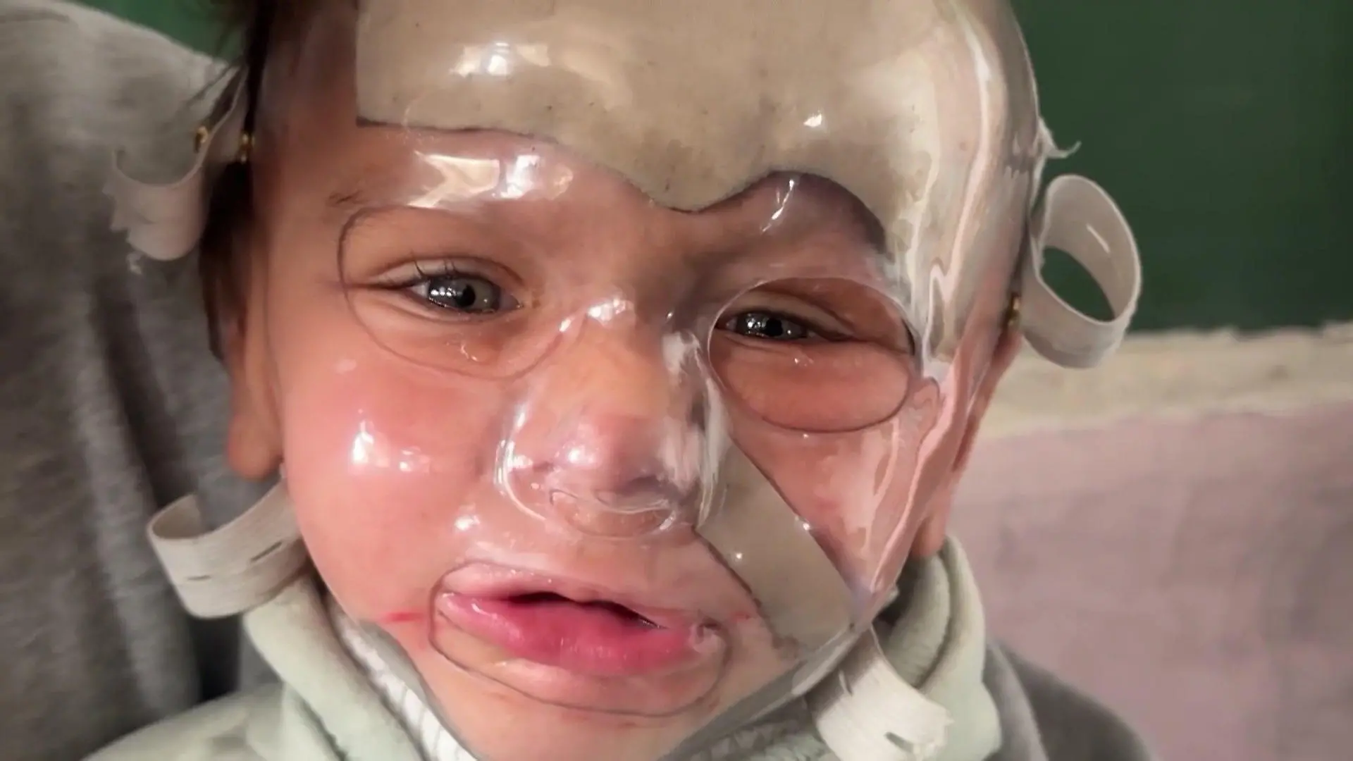 Seine Haut heilt nicht mehr! Mohammed (1) überlebt nur mit dieser Spezialmaske „Ärzte ohne Grenzen“ im Gazastreifen