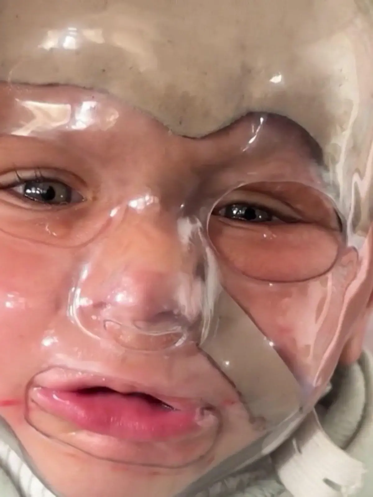 Bild zu: "Seine Haut heilt nicht mehr! Mohammed (1) überlebt nur mit dieser Spezialmaske"