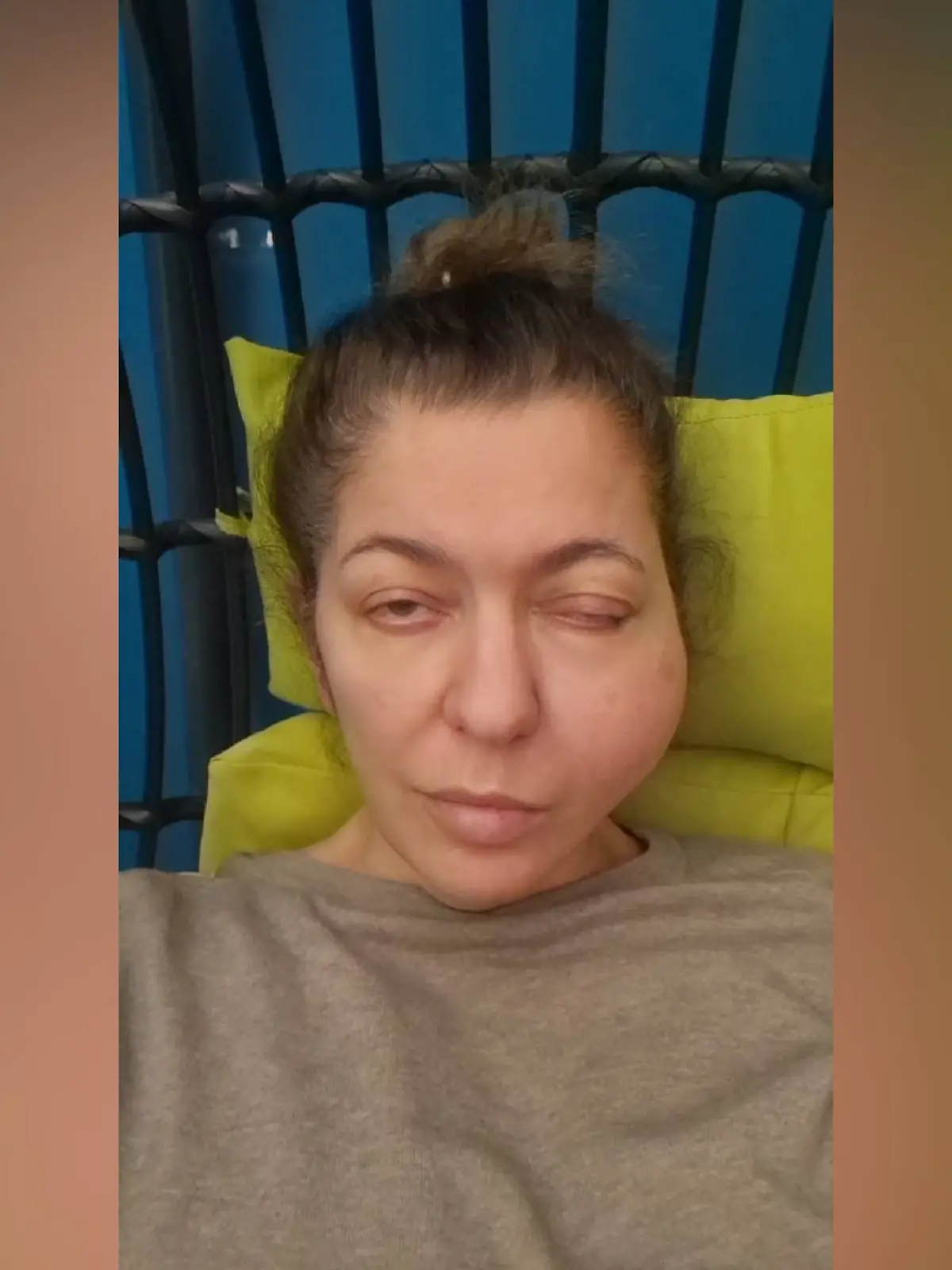 Das ist Stavi heute mit den seltenen Tumoren