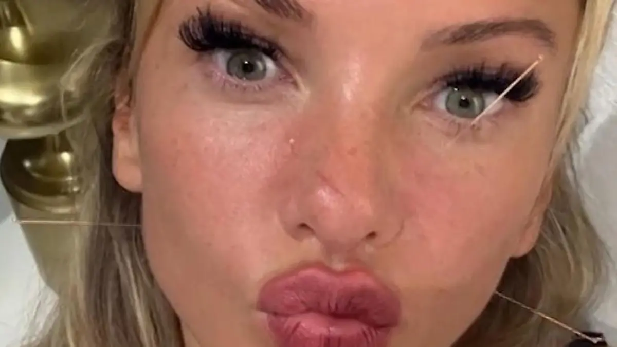 Bild zu: "Autsch, Evelyn! Was ist mit deinem Gesicht passiert?"