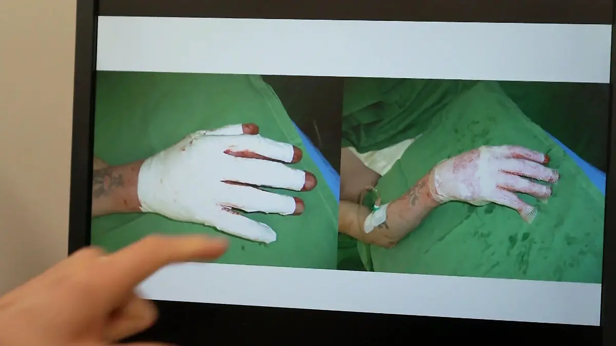 Eine künstliche Ersatzhaut beschleunigt die Heilung Ersatzhaut, Unfall, Hautverbrennung