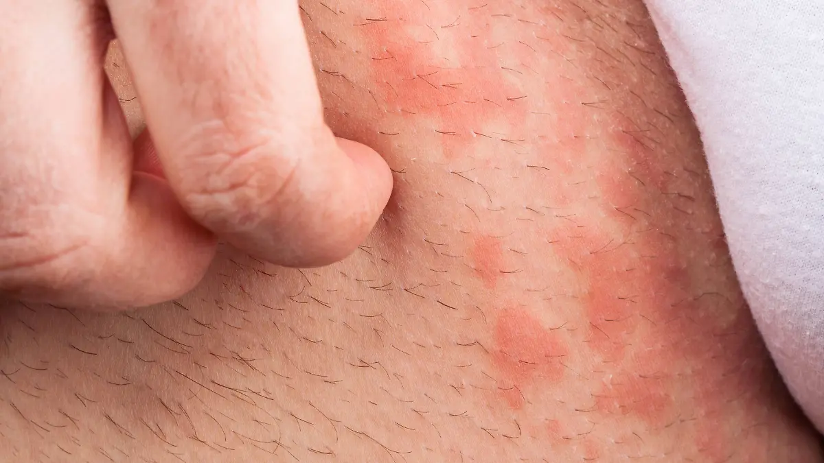 kratzen,jucken,juckreiz,nesselfieber *** scratching,itching 1un-h77