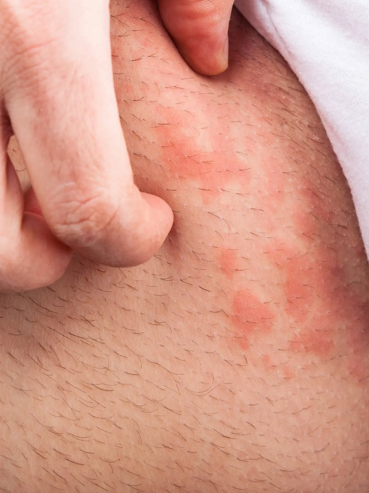 kratzen,jucken,juckreiz,nesselfieber *** scratching,itching 1un-h77