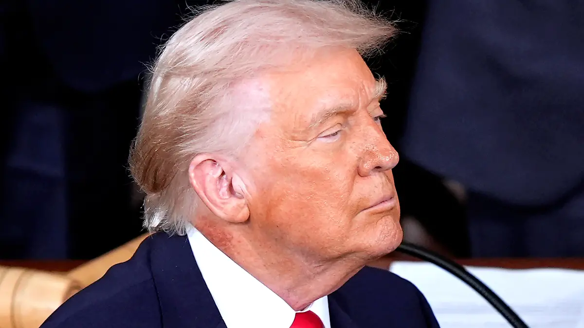 Redness is seen on the neck of President Donald Trump as he delivers the State of the Union address to a joint session of Congress in the House chamber at the U.S. Capitol in Washington, Tuesday, Feb. 24, 2026. (AP Photo/Mark Schiefelbein)