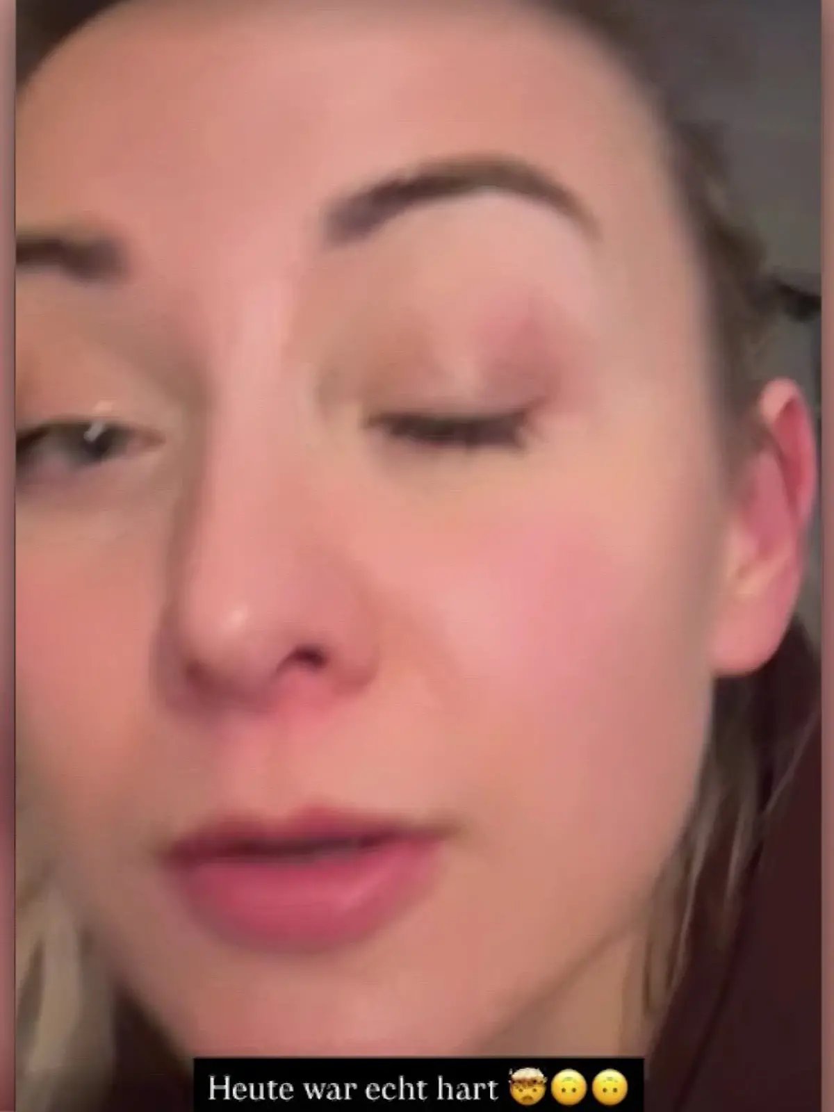 Anna-Carina Woitschak hat ein blaues Auge