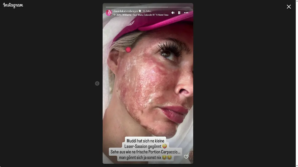 Daniela Katzenbergers Beauty-Behandlung verlief schmerzhafter als gedacht.