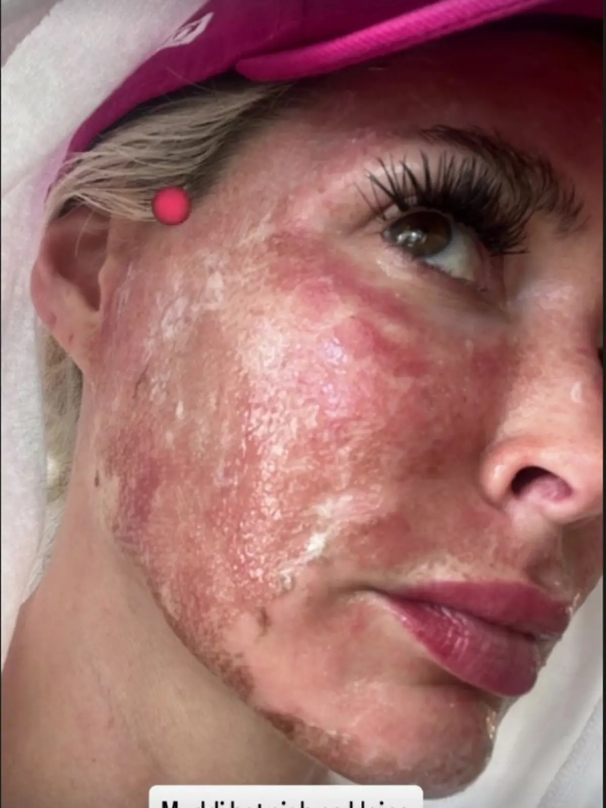 Daniela Katzenbergers Beauty-Behandlung verlief schmerzhafter als gedacht.