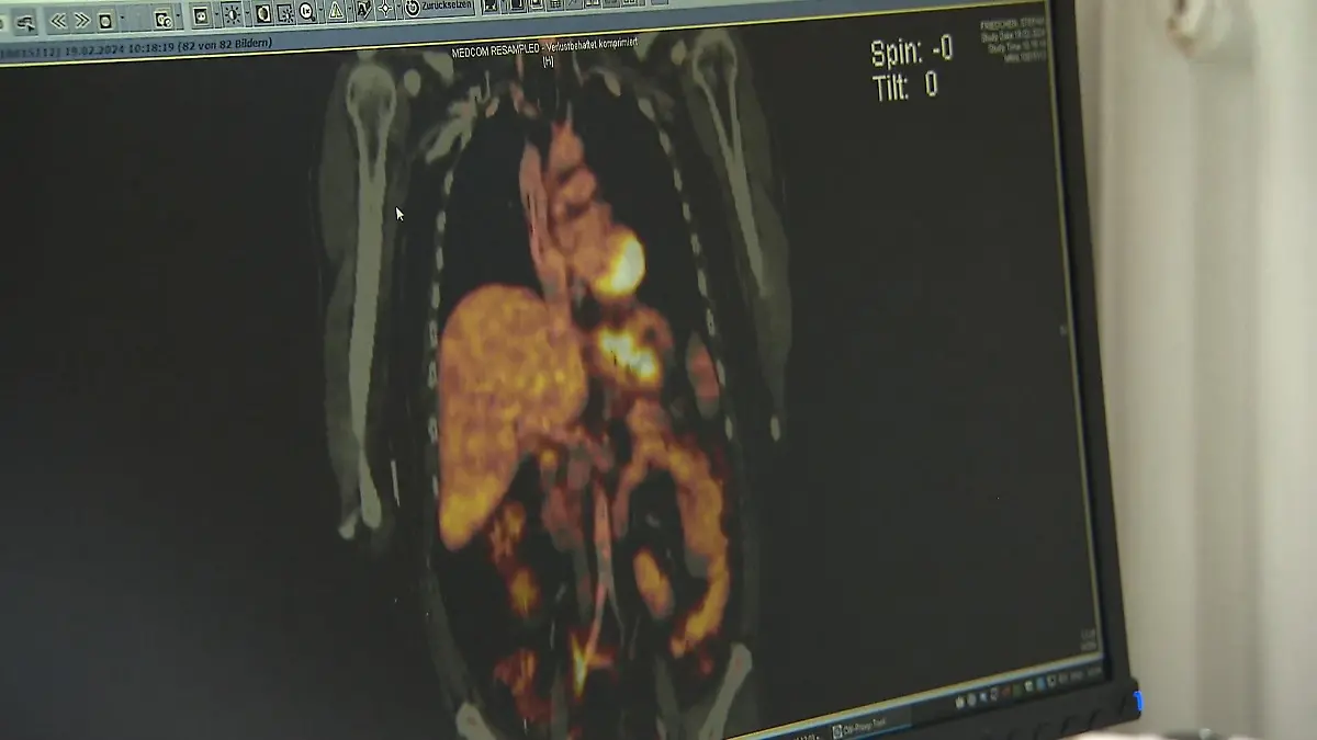 Diese Entdeckung ist eine kleine Sensation – Bakterium im Mund kann Magenkrebs auslösen