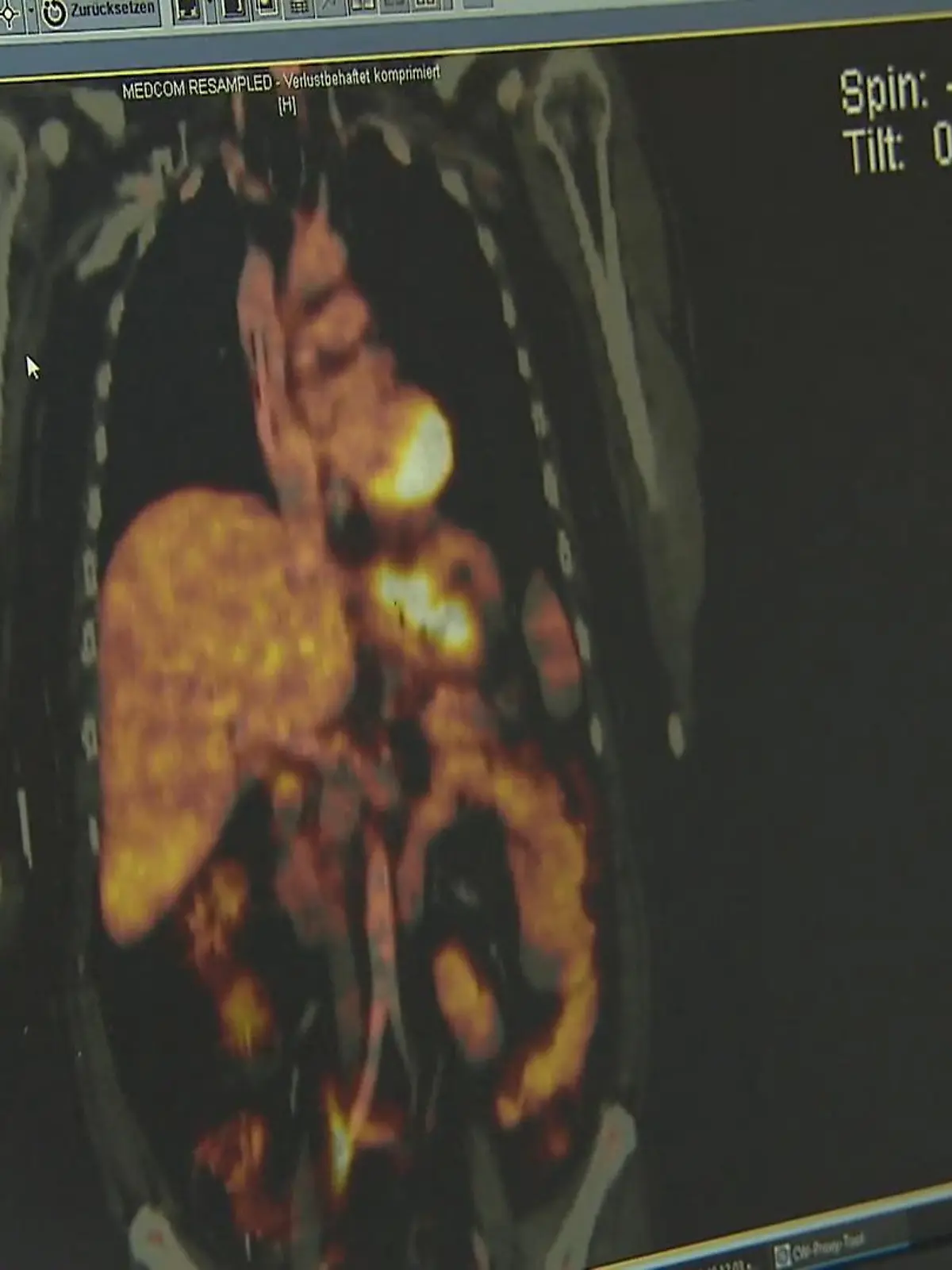 Forscher konnten möglicherweise einen Durchbruch in der Früherkennung von Magenkrebs erzielen