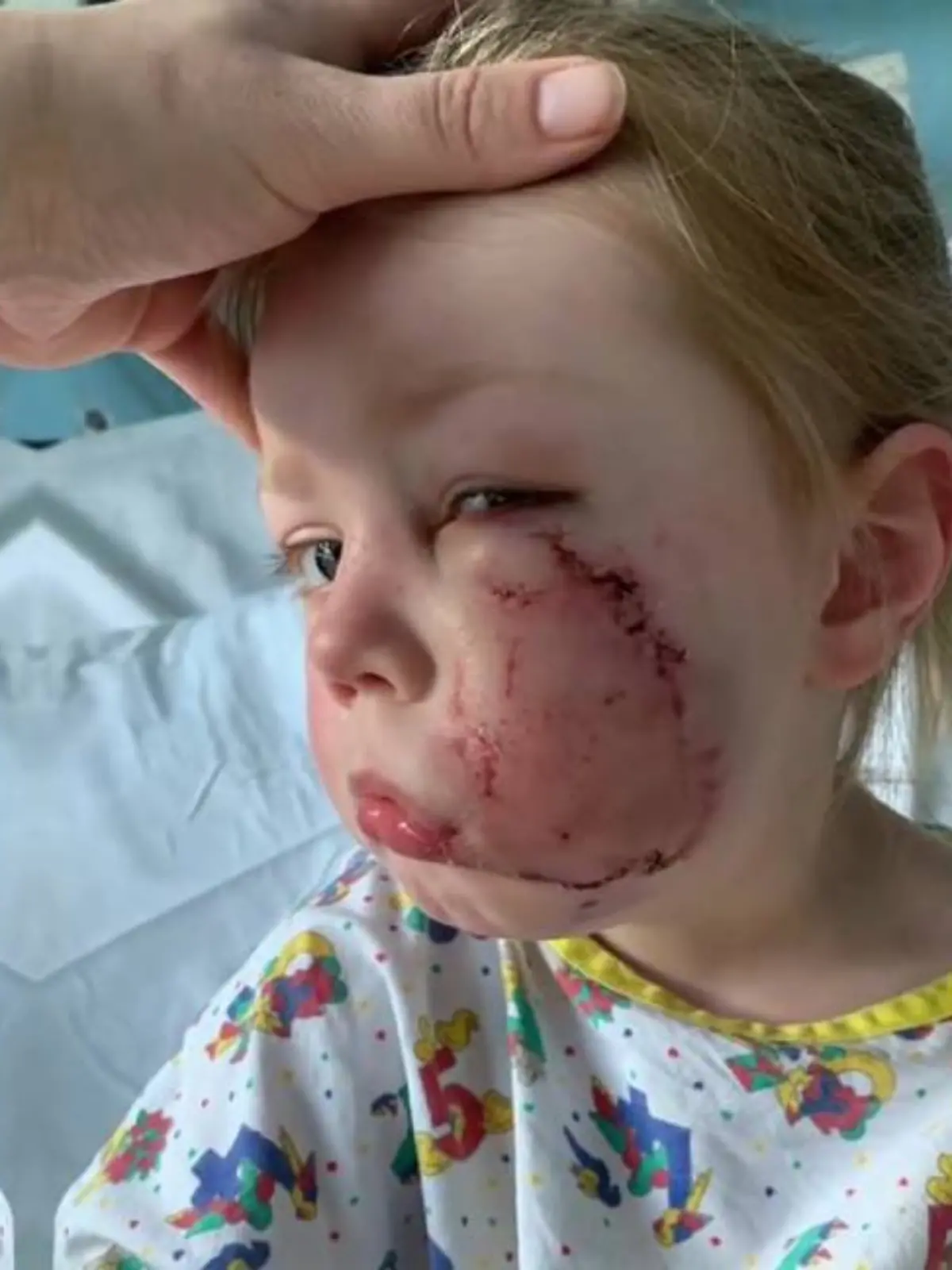 Die Bisswunden der kleinen Luna-Ann waren so tief, dass man durch die Wange in ihren Mund blicken konnte.