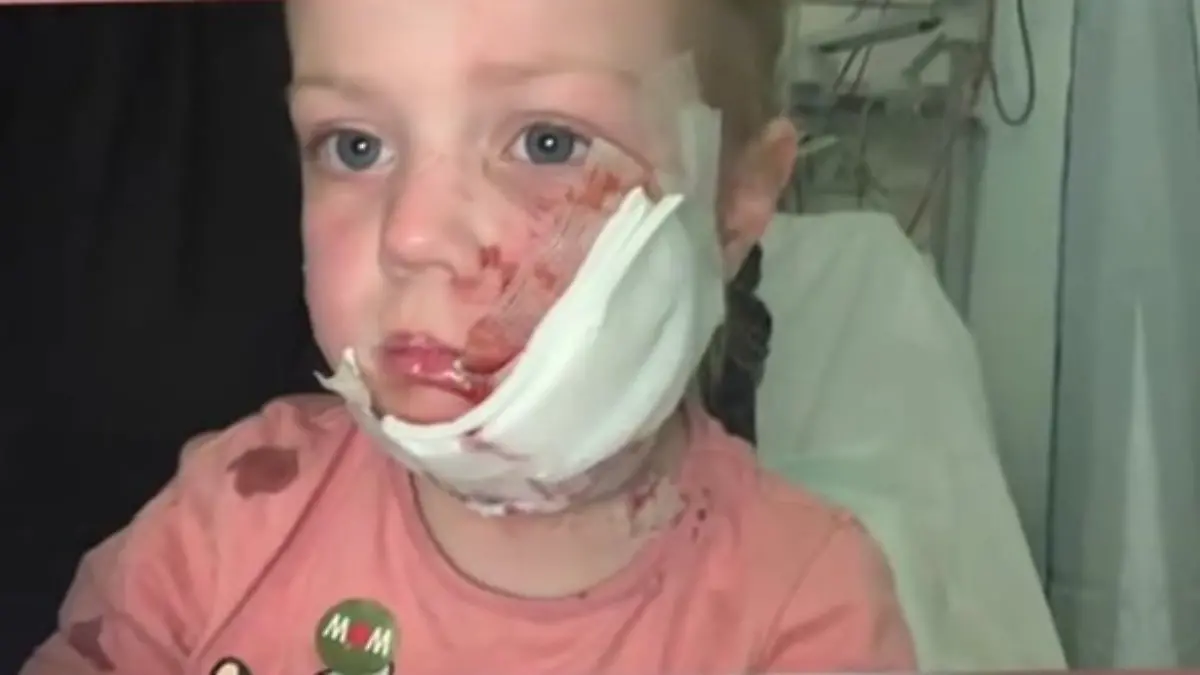 Mehrere Operationen müssen Lunas entstelltes Gesicht retten. Die tiefen Narben und das Trauma werden das Mädchen wohl ein Leben lang begleiten.