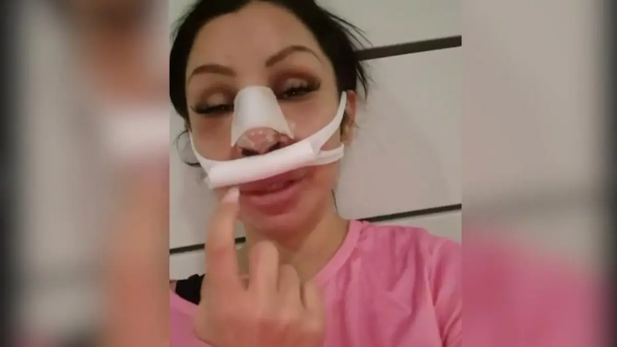 Reality-Star Pinar Sevim zeigt sich direkt nach ihrer zweiten Nasen-OP.