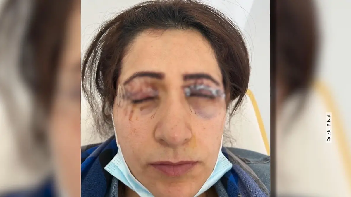 Augenlid-OP geht schief – Patientinnen berichten von schlimmen Folgen Verpfuschte Beauty-OP