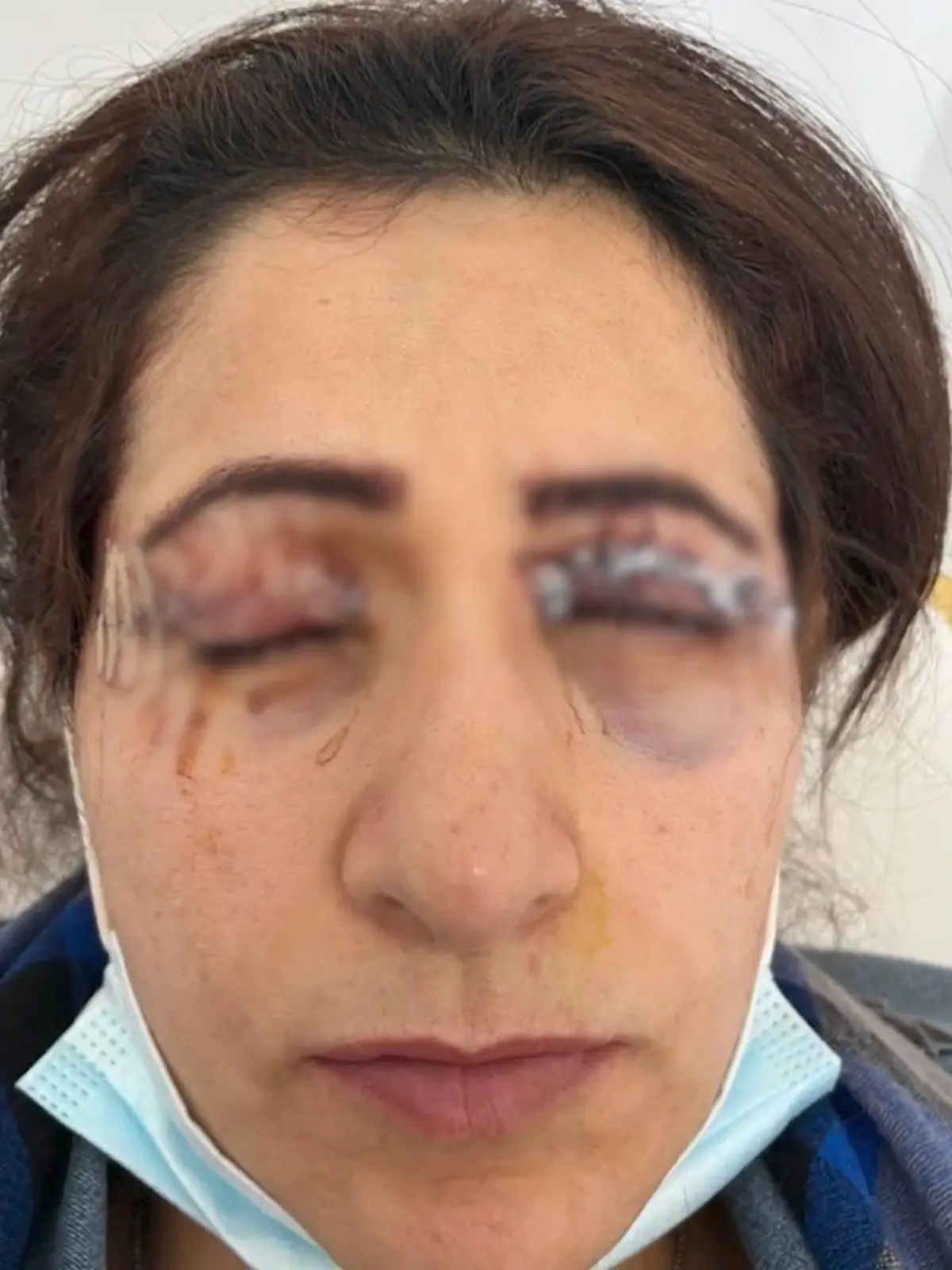 Bild zu: "Augenlid-OP geht schief – Patientinnen berichten von schlimmen Folgen"