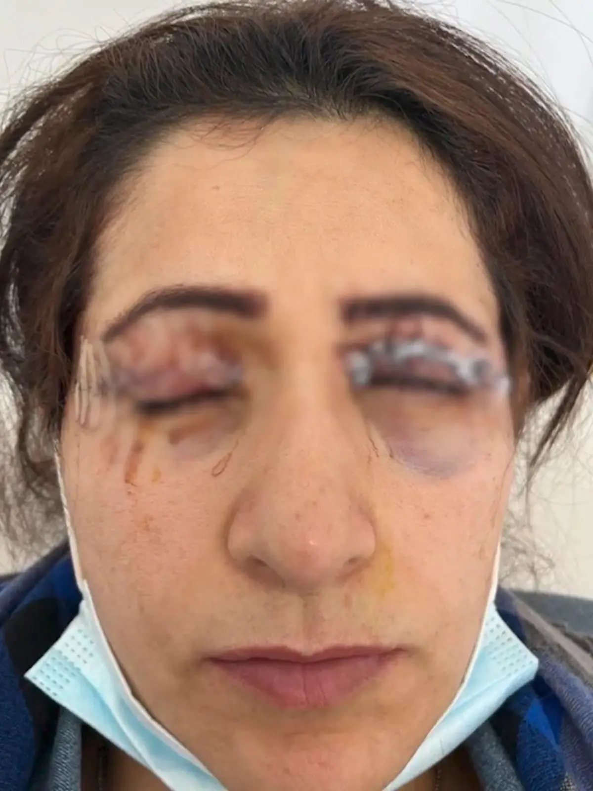 Nach einer Lidstraffung leidet Nasrin V. bis heute unter schweren Folgen. Jetzt müssen sich die Verantwortlichen vor Gericht verantworten. 