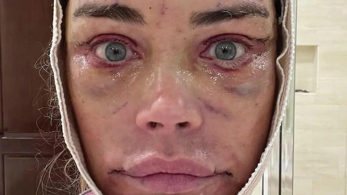 Plötzlich 20 Jahre jünger! Denise Richards sieht nach OP-Marathon jetzt SO aus Sie zeigt Vorher-Nachher-Bilder