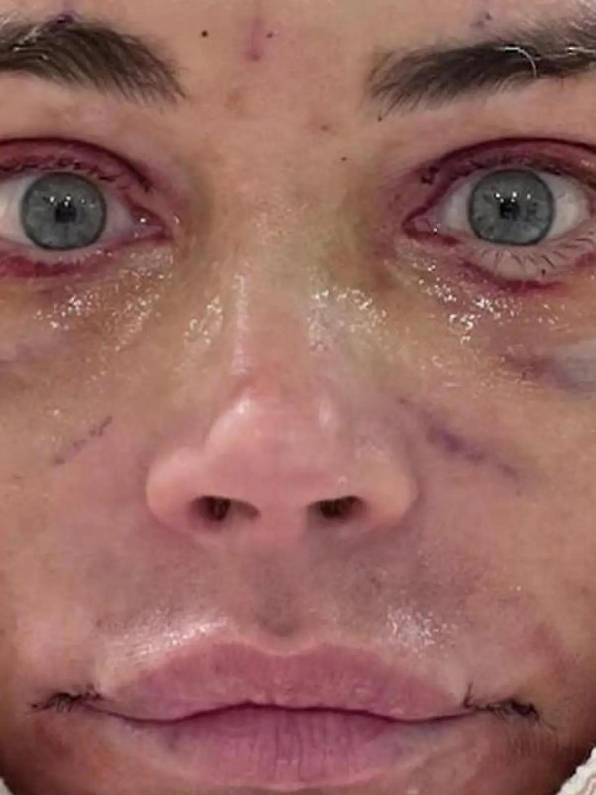 Bild zu: "Plötzlich 20 Jahre jünger! Denise Richards sieht nach OP-Marathon jetzt SO aus"