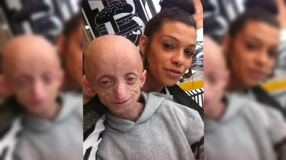 Krankes Kind mit Benjamin Button Syndrom und Mutter