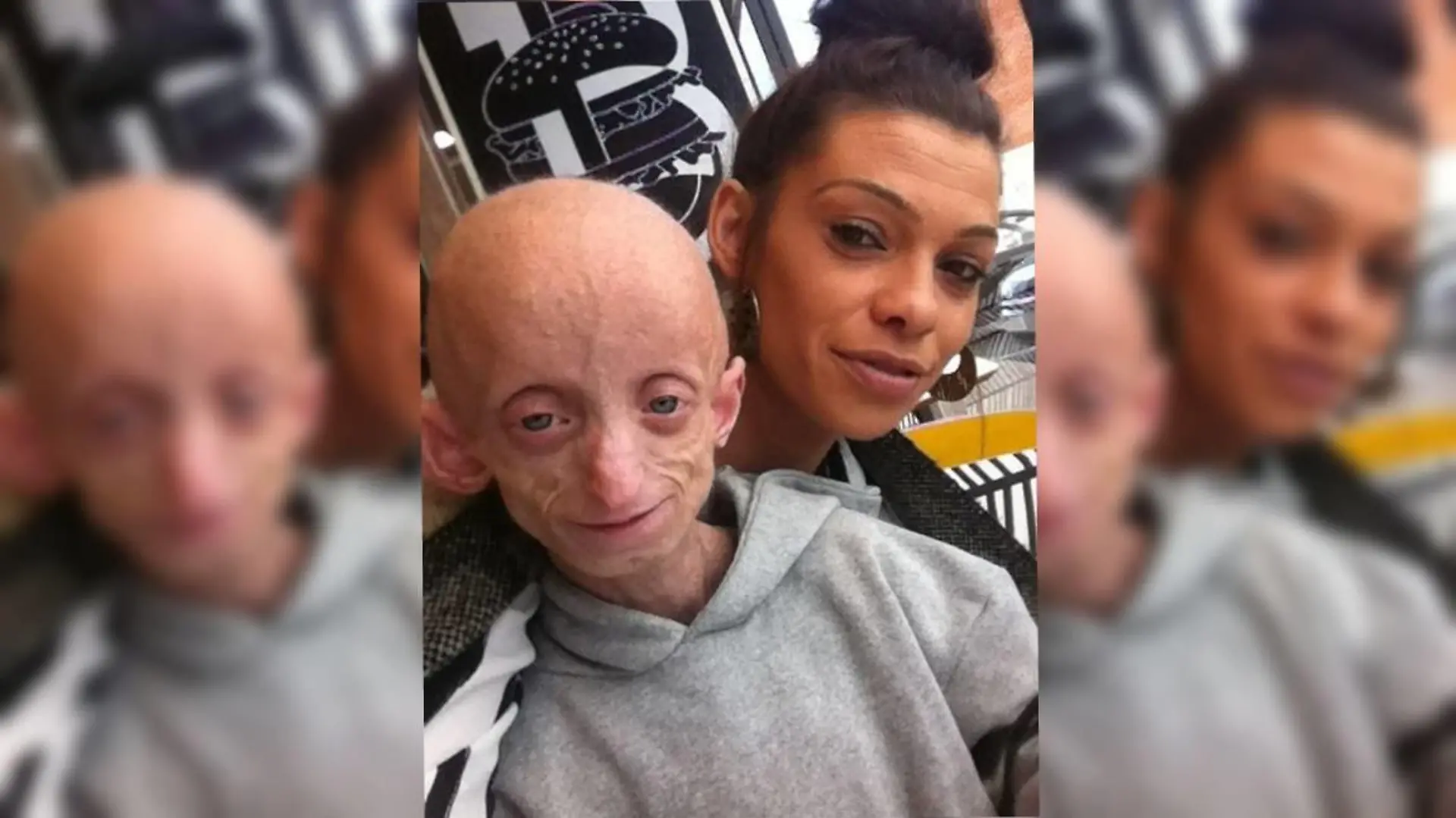 Krankes Kind mit Benjamin Button Syndrom und Mutter