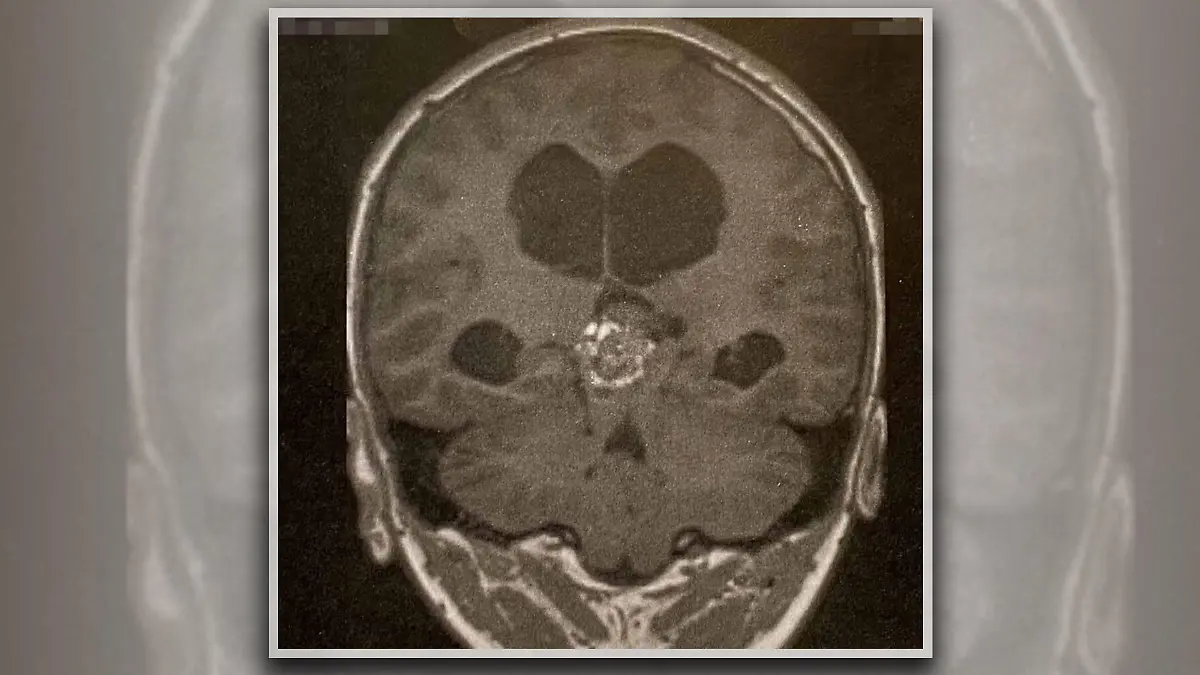 Optiker entdeckt bei Routine-Augen-Untersuchung bösartigen Tumor bei 13-Jährigem.