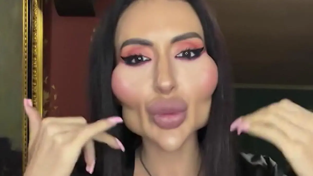 Anastasia will die größten Wangen der Welt – jetzt fühlt sie sich endlich schön! Vorher-Nachher-Fotos nach Beauty-OP