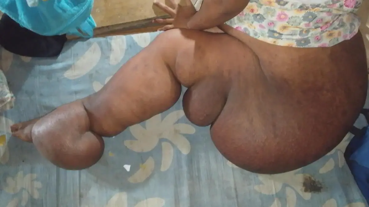 Unheilbar krank! Dreifach-Mama leidet unter „Elefanten-Beinen" Täglicher Kampf für ihre Familie