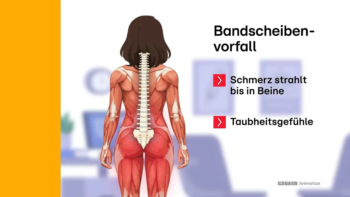 Wie ihr einen Hexenschuss von einem Bandscheibenvorfall unterscheidet Ähnliche Symptome