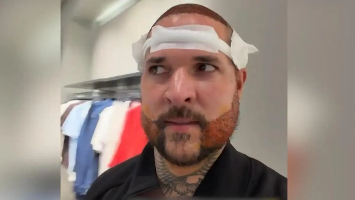 „Ich fühle mich wie ein Monster!" Reality-Star macht nach Beauty-OP Kindern Angst Haartransplantation bei Zico Banach