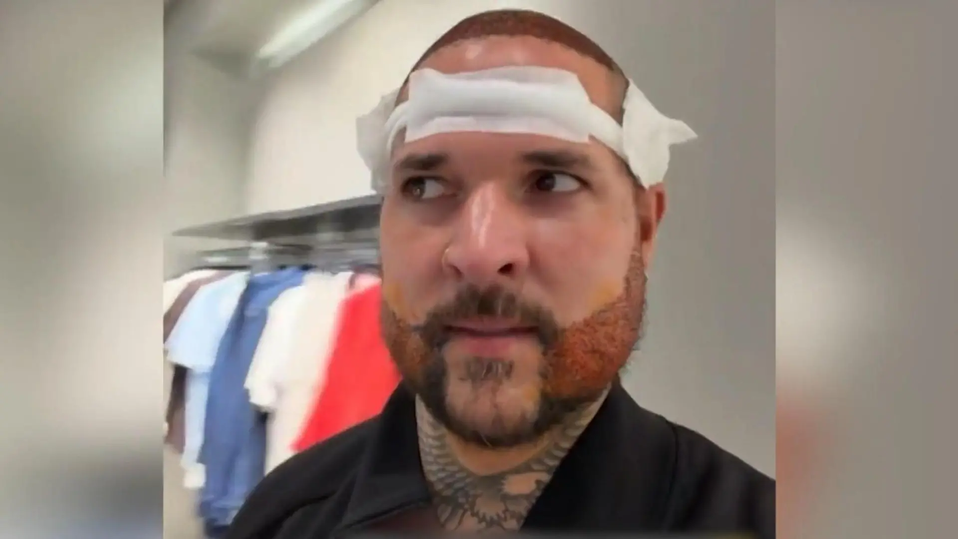 „Ich fühle mich wie ein Monster!" Reality-Star macht nach Beauty-OP Kindern Angst Haartransplantation bei Zico Banach