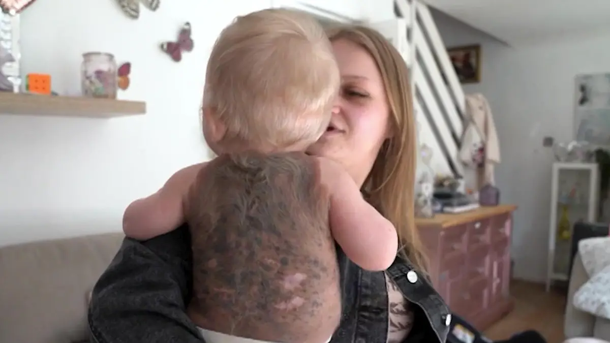 Rücken mit Muttermalen überwuchert! Horror-Diagnose für Baby Macey-Mai Seltener Hautkrebs