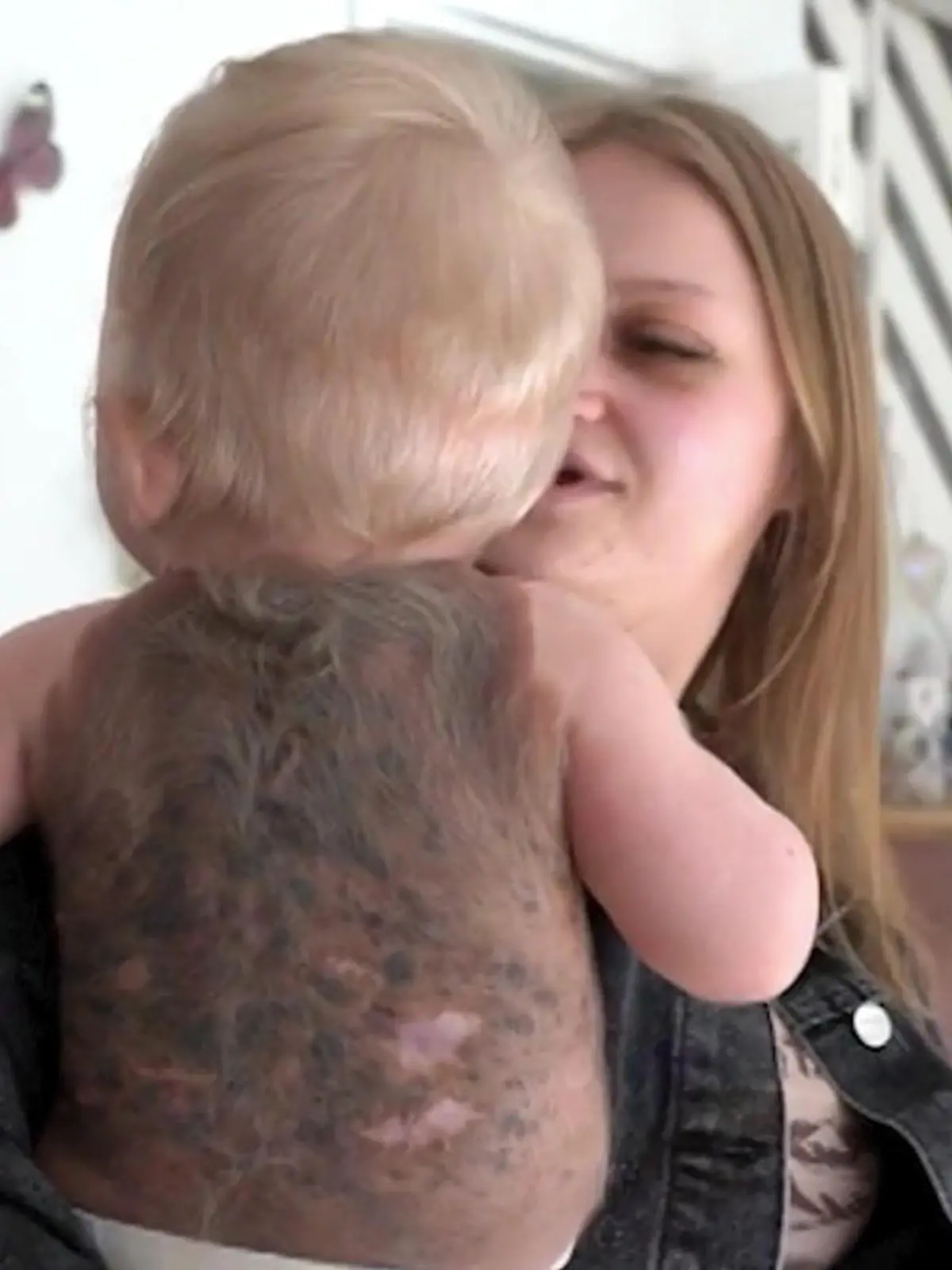 Bild zu: "Rücken mit Muttermalen überwuchert! Horror-Diagnose für Baby Macey-Mai"