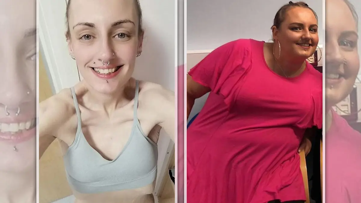 Links ist die magersüchtige Natalie, die vorher jahrelang mit 120 stark übergewichtig war.