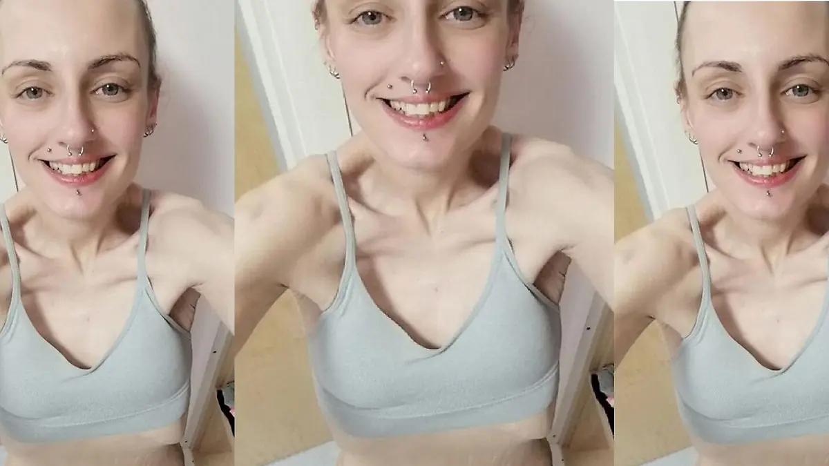 Man sieht eine stark untergewichtige Frau, dessen Rippen herauskommen.