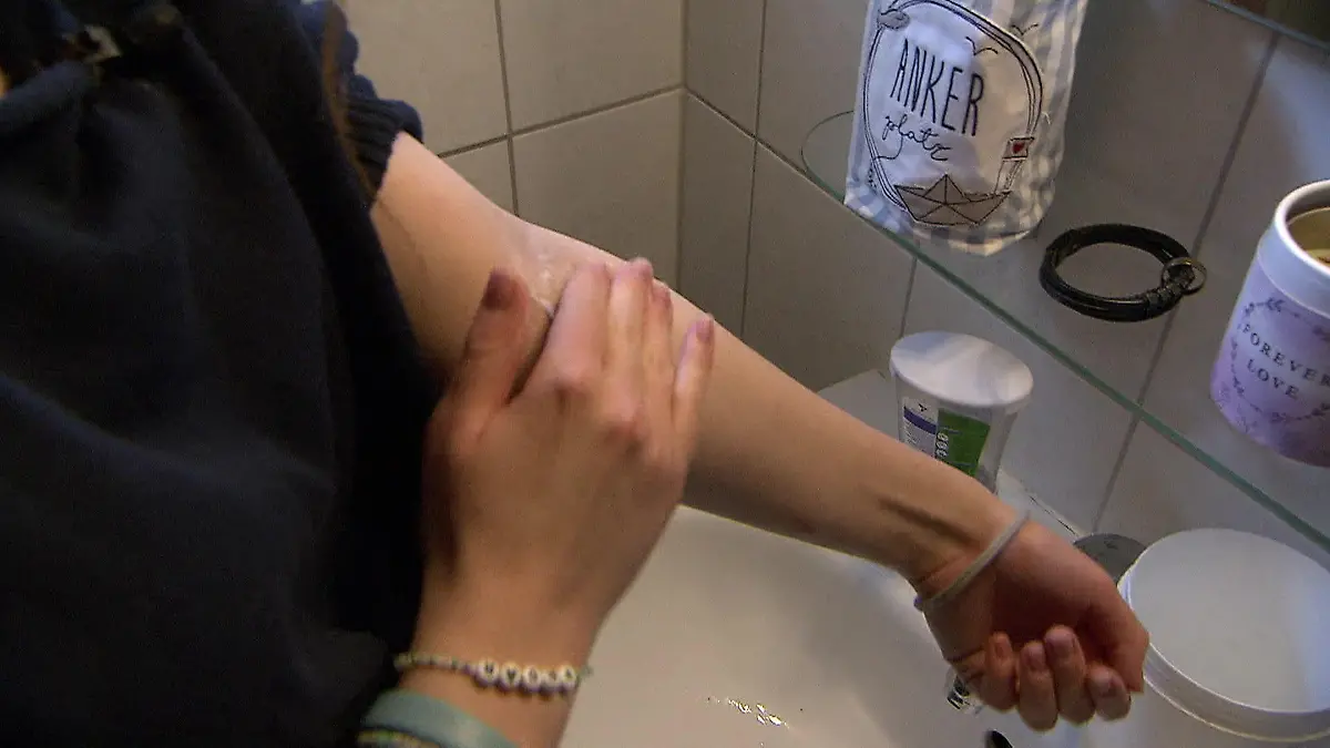 Wie die Ernährung den Verlauf der Hauterkrankung beeinflussen kann Neurodermitis im täglichen Leben