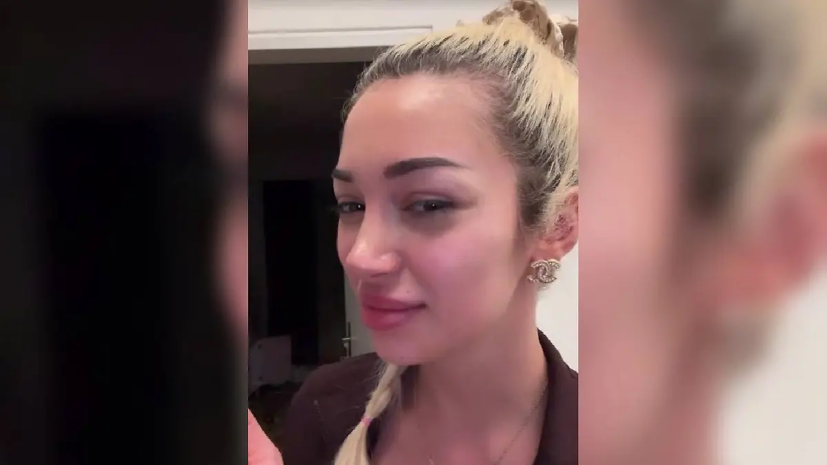 Ariel zeigt, wie ihre Oberlippe nach der Filler-Entfernung aussieht.