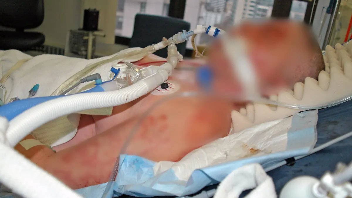 Eine Frau wird im Krankenhaus beatmet. Der ganze Körper ist übersät mit Brandwunden und Narben.