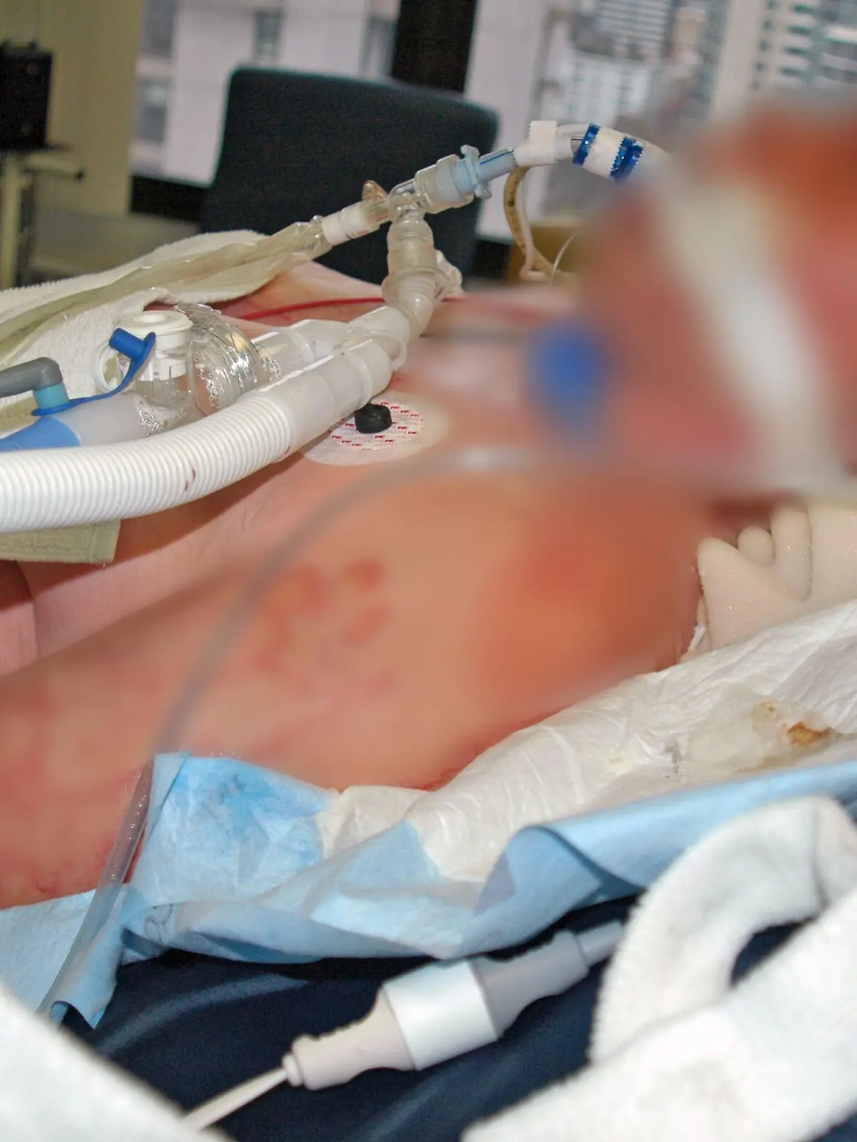 Eine Frau wird im Krankenhaus beatmet. Der ganze Körper ist übersät mit Brandwunden und Narben.