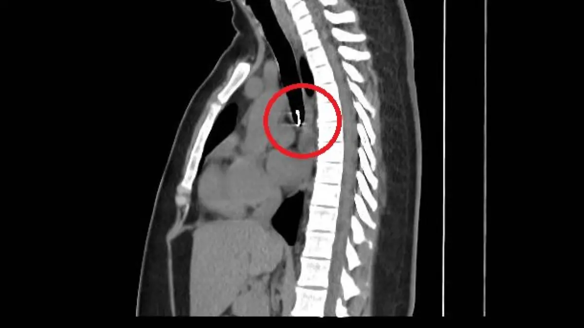 Das Metallobjekt befand sich nur etwa einen halben Millimeter von der Aorta entfernt, der Hauptschlagader des Körpers.