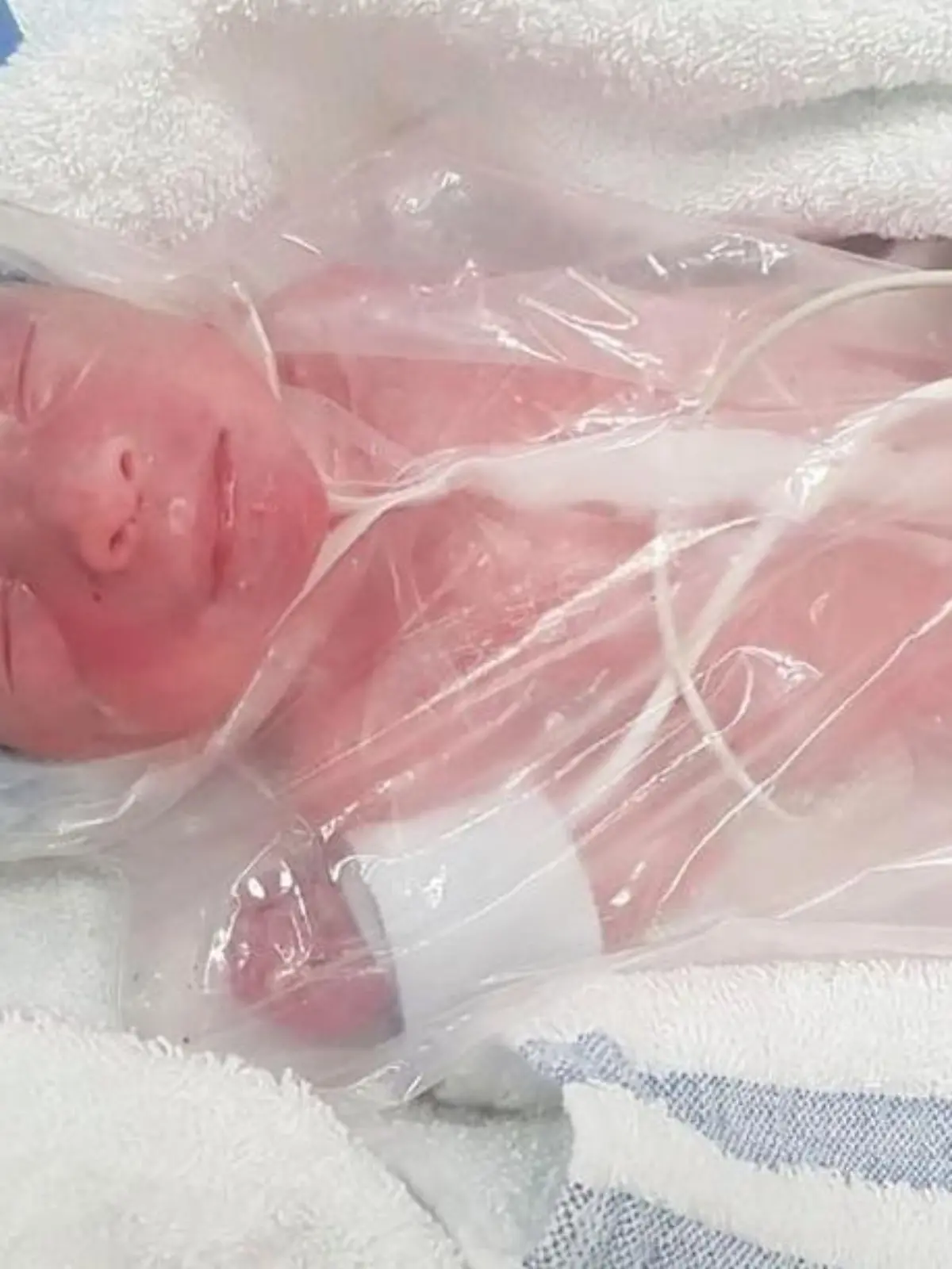 Baby Zaki ist eingewickelt in einer Sandwich-Tüte. Der Kleine kommt drei Monate zu früh zur Welt. Im Mutterbauch hätte er es jetzt noch schön warm gehabt.
