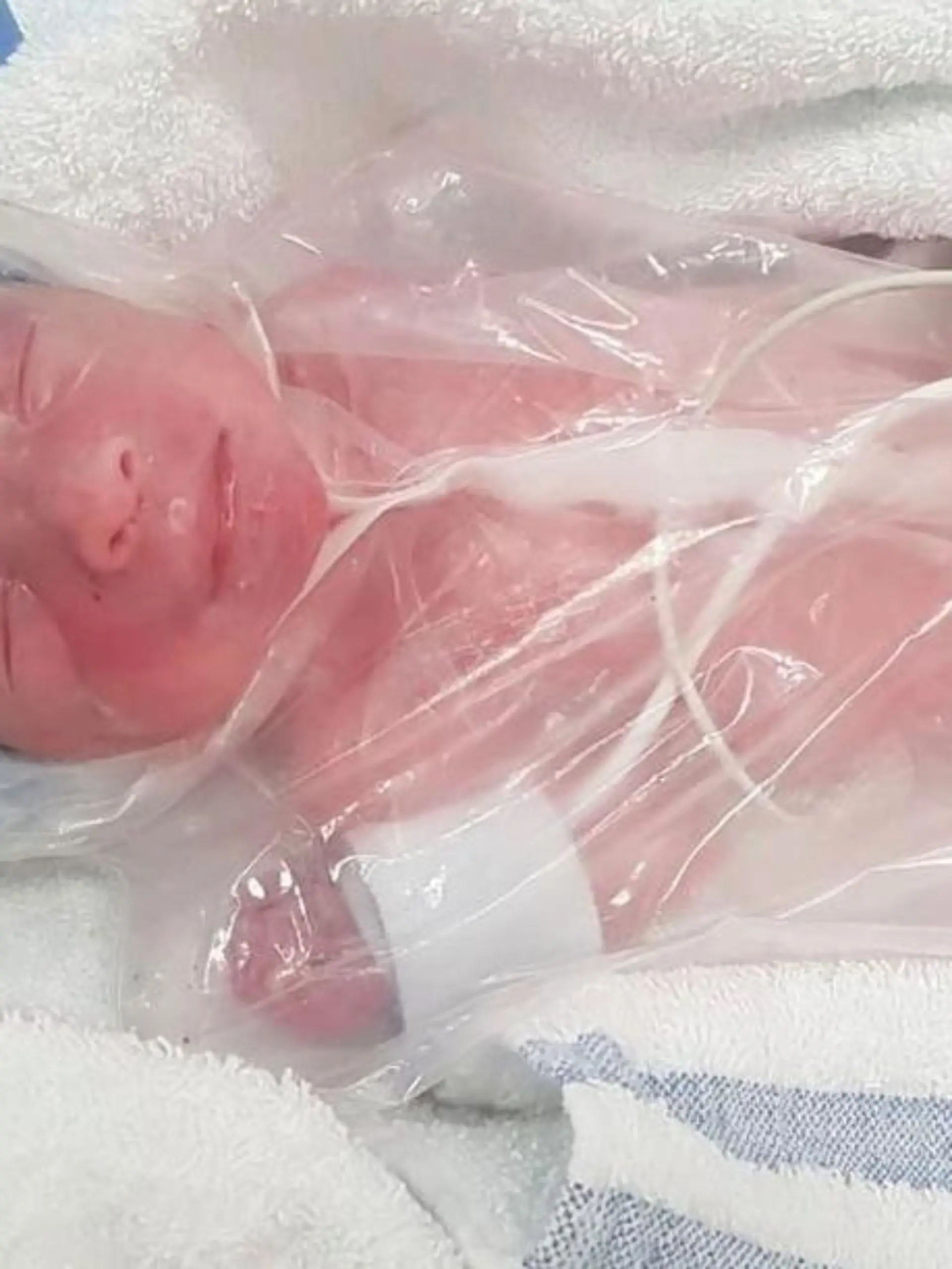 Baby Zaki ist eingewickelt in einer Sandwich-Tüte. Der Kleine kommt drei Monate zu früh zur Welt. Im Mutterbauch hätte er es jetzt noch schön warm gehabt.