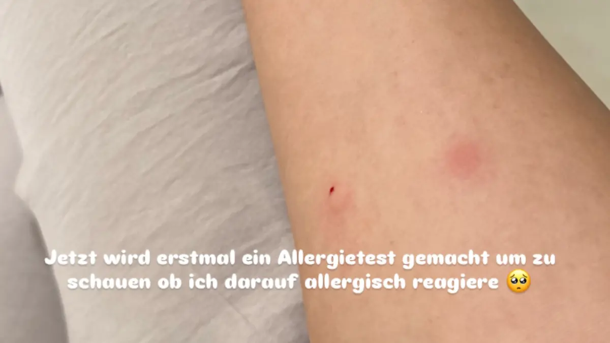 Vor der Impfung wurde bei Leyla noch ein Allergietest gemacht. 