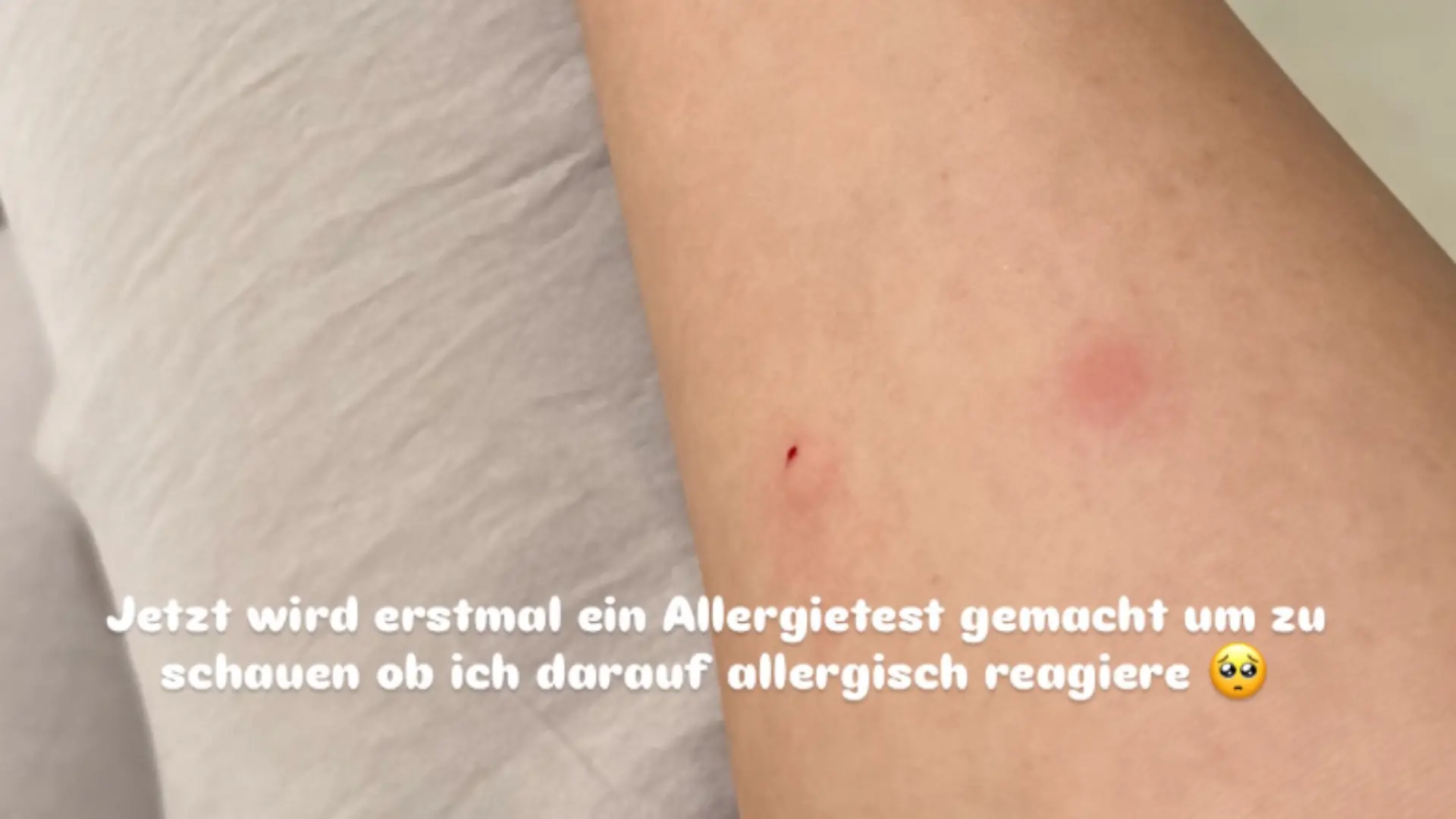 Vor der Impfung wurde bei Leyla noch ein Allergietest gemacht.