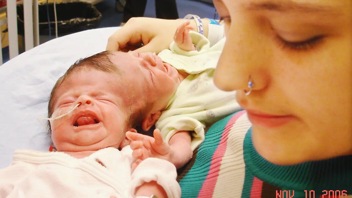 CANADA CONJOINED TWINS