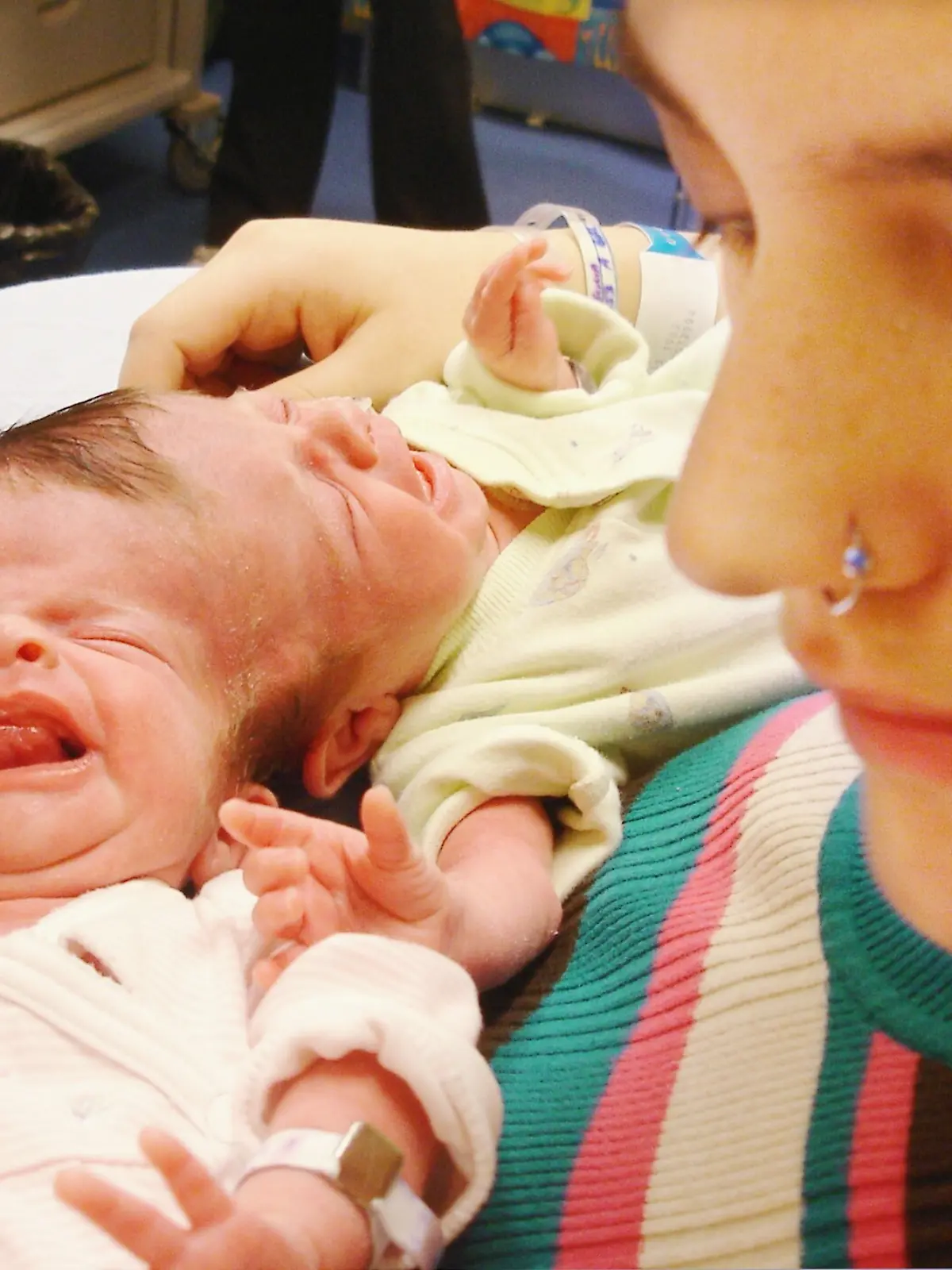 CANADA CONJOINED TWINS