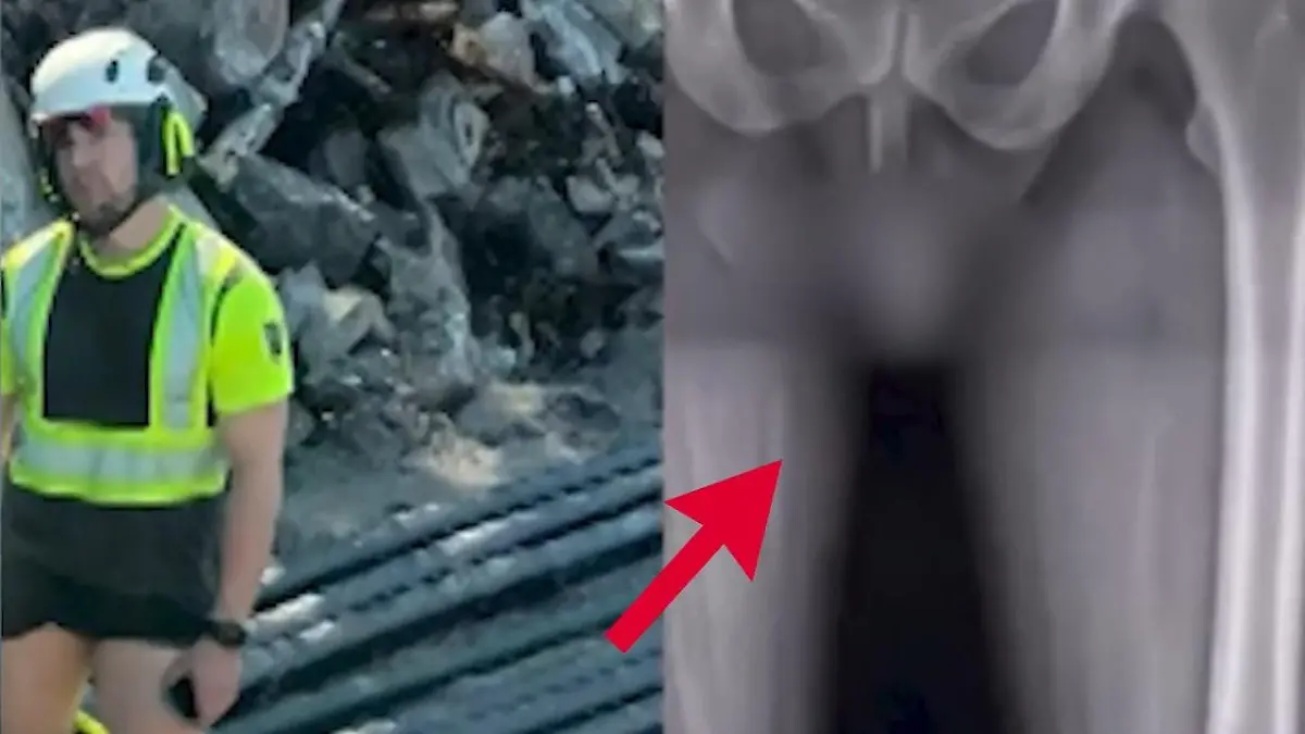 Peinliche Penis-Panne! Marco teilt versehentlich pikantes Foto Sein Röntgenbild wird millionenfach geklickt