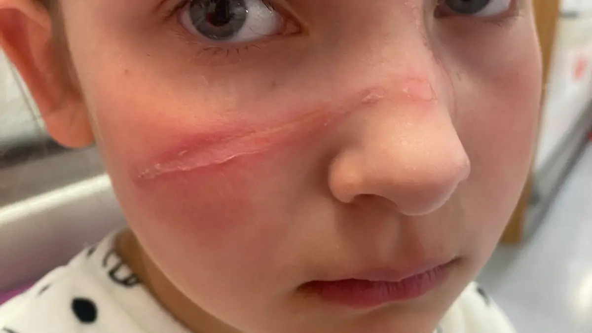 Die kleine Bella landete wegen einer TikTok-Challenge im Krankenhaus