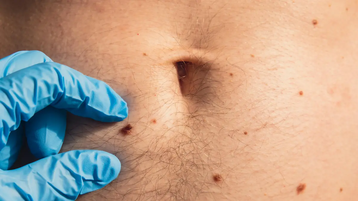 Dermatologist checking male birthmarks. Doctor in medical gloves examining man skin mole. Self care preventing cancer procedure. Protection treatment. Imperfection skin positivity