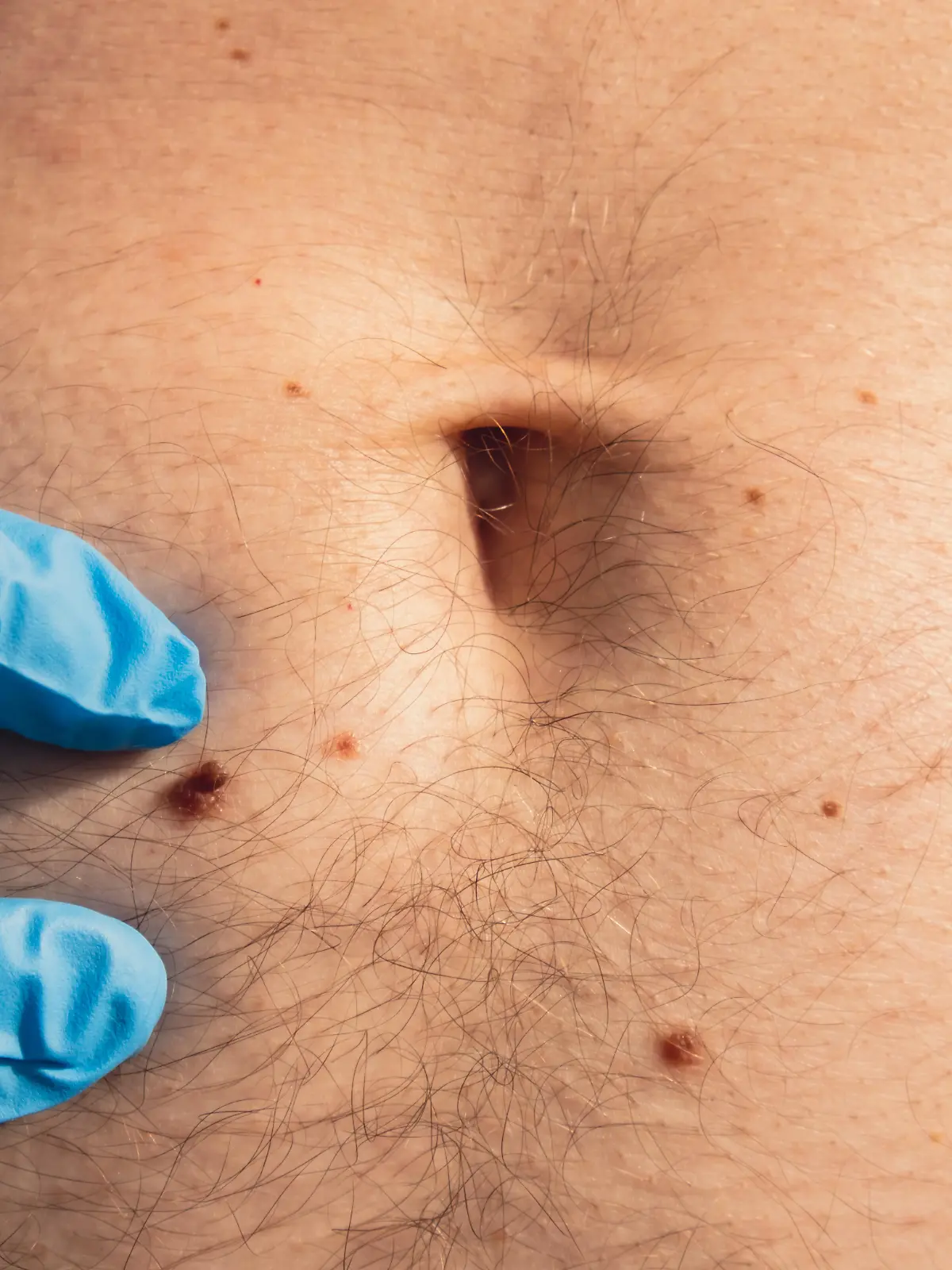 Dermatologist checking male birthmarks. Doctor in medical gloves examining man skin mole. Self care preventing cancer procedure. Protection treatment. Imperfection skin positivity